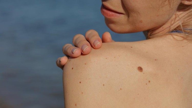 Checking benign moles : Beautiful Woman with birthmarks on her back and face. Laser skin tags removal