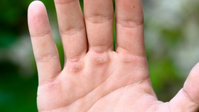 3 Kebiasaan Penyebab Tangan Kapalan yang Bikin Enggak <i>Pede</i>