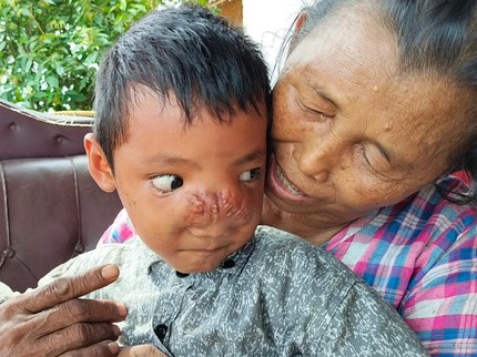 Dilanda Tumor Hidung, Nasib Miris Dilan Ditinggal Ibu dan Diejek Teman