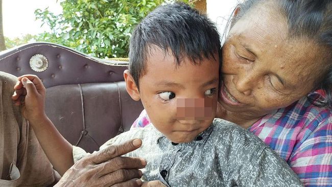Mari salurkan donasi untuk membantu pengobatan dan operasi Dilan, balita penderita tumor hidung asal Lampung Timur melalui Berbuatbaik.id.