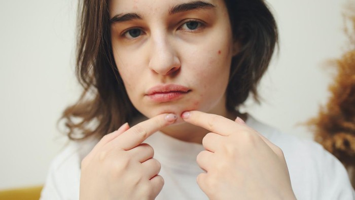 Kamu Perlu Tahu, Ini Alasan Kenapa Jerawatmu Muncul Lagi Muncul Lagi!