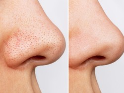 12 Cara Menghilangkan Komedo Hitam di Hidung dengan Cepat