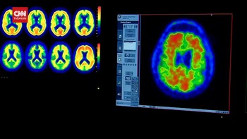 VIDEO: Lecanemab, Obat yang Mampu Mengurangi Gejala Alzheimer