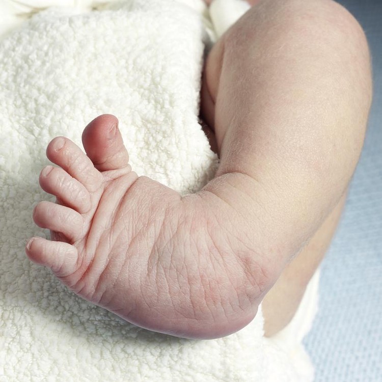 Ilustrasi Clubfoot Ilustrasi Clubfoot