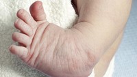 Cerita Bunda Obati Anak yang Alami Kaki Pengkor Digips dari Bayi hingga Rela Pindah ke Solo