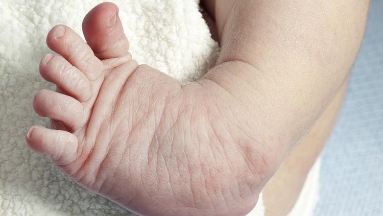 Ilustrasi Clubfoot Ilustrasi Clubfoot