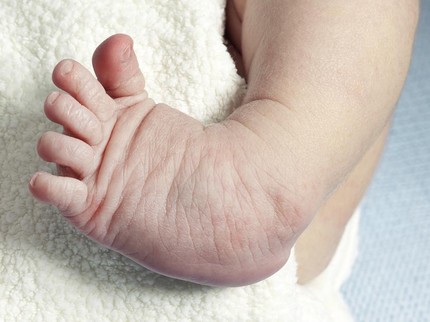 Cerita Bunda Obati Anak yang Alami Kaki Pengkor Digips dari Bayi hingga Rela Pindah ke Solo