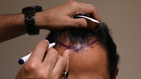 img-title Ingin Tampan, Transplantasi Rambut Malah Berujung Maut di India