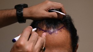 Ingin Tampan, Transplantasi Rambut Malah Berujung Maut di India