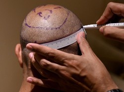 Bolehkah Transplantasi Rambut? Begini Hukumnya dalam Islam