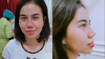 Ini 7 Potret Perubahan Hidung Baru Mayang Setelah Lepas Perban Operasi