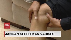 VIDEO: Jangan Sepelekan Varises