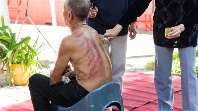 Sejumlah studi menemukan beberapa manfaat kerokan, atau yang dalam pengobatan tradisional China dikenal dengan sebutan gua sha. Berikut di antaranya.