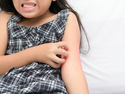 Cara Bedakan Bintik Gigitan Nyamuk DBD dengan Bentol Biasa