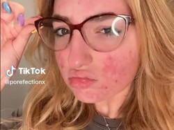 Ratu Kecantikan Berjerawat Diblokir TikTok, Kontennya Disebut Mengerikan