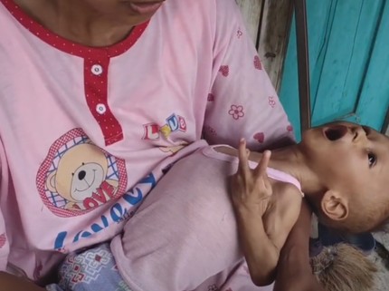 Sedihnya Adik Salman Kurus hingga Tak Bisa Tegakkan Leher karena Gizi Buruk