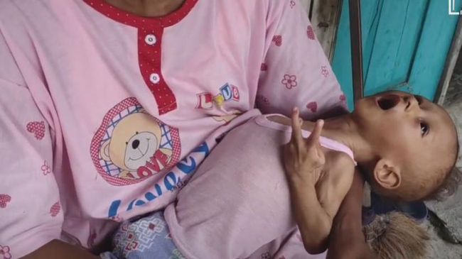 Salurkan donasi untuk penyembuhan Salman, balita dua tahun yang menderita gizi buruk akibat kemiskinan melalui berbuatbaik.id.