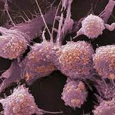 9 Gejala Awal Kanker yang Sering Terabaikan, Kenali Segera!