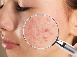 Mengenal Rosacea, Penyakit Kulit yang Sering Dikira Jerawat