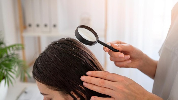 Kamu Perlu Tahu! Ini Perbedaan Masalah Ketombe dan Kulit Kepala Kering pada Rambut, serta Cara Perawatan yang Benar