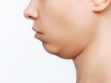 Badan Kurus tapi Double Chin, Kok Bisa? Kenali Penyebab dan Cara Mengatasinya