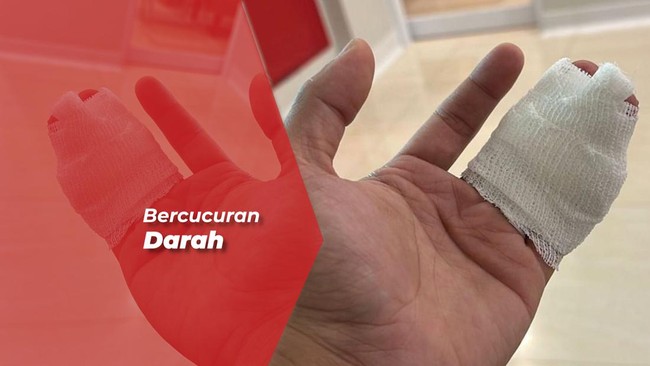 Jari Terjepit Pintu Garasi, Glenn Alinskie sampai Dilarikan ke IGD