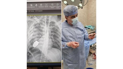 img-title Dokter Angkat Granat Aktif dari Tubuh Tentara Ukraina, Simak Tekniknya