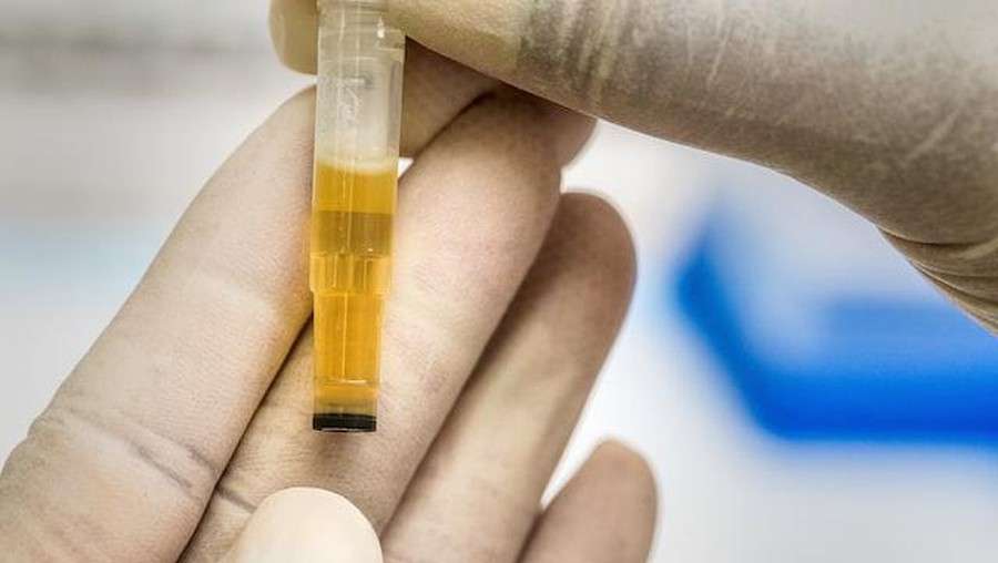 Ilustrasi tes albumin dalam urine&period;