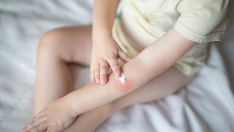 Biang Keringat Obat Biang Keringat