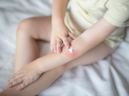 5 Masalah Infeksi Kulit Anak di Musim Kemarau & Cara Mencegahnya