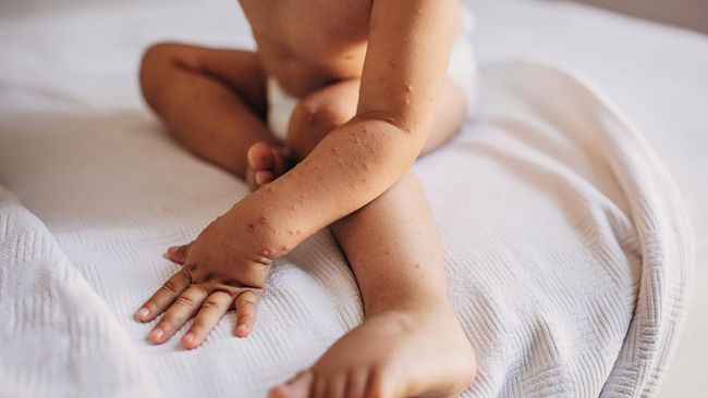 Wabah Campak Tewaskan Ratusan Anak Di Negara Ini