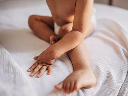 Waspada Kasus Campak Merebak Kembali, Sudahkah Anak-anak Divaksinasi?