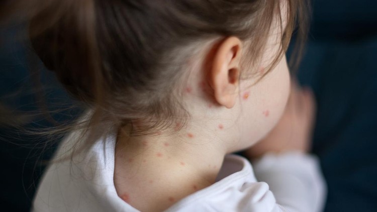 Ilustrasi Campak pada Anak Close-up of a girl with chickenpox measles on the body