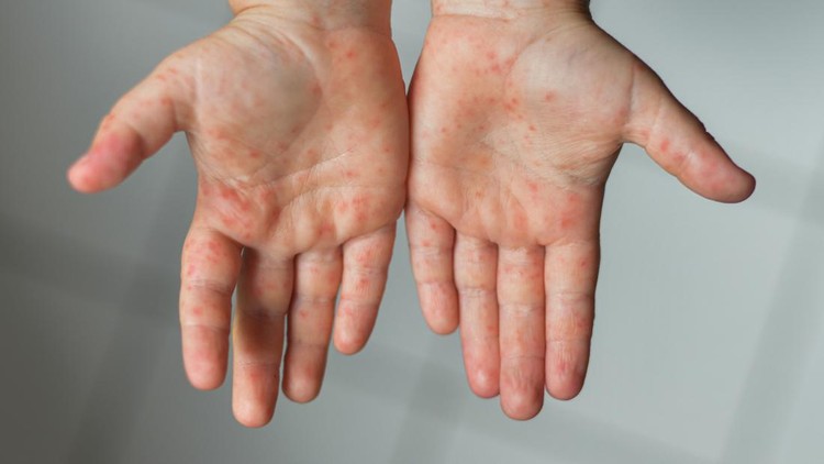 Ilustrasi Campak pada Anak Enterovirus Legs hands mouth Rash on the body of a child Cocksackie virus