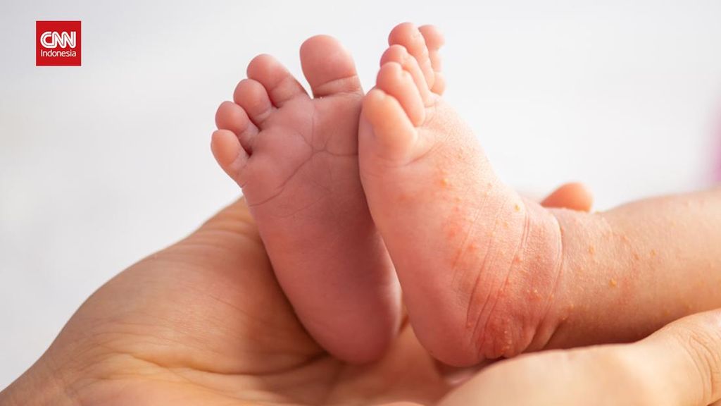 Lebaran 2026, Waspada Campak di Tengah Mobilitas Tinggi