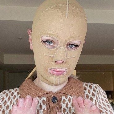 Ditutupi Topeng selama 2 Tahun, Begini Wajah Korban Letusan Gunung Berapi