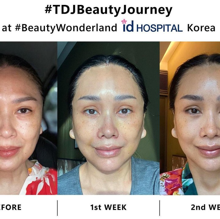 <p>Dipostingan lain, ibunda Stephanie Poetri ini menyebut ada lima operasi yang dijalaninya. Di antaranya adalah <em>Face Lift, Forehead Lift, Neck Lift, Lower Blepharoplasty, dan Fat Graft.</em> (Foto: Instagram @ti2dj) <br /><br /><br /></p>