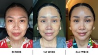 <p>Dipostingan lain, ibunda Stephanie Poetri ini menyebut ada lima operasi yang dijalaninya. Di antaranya ialah <em>Face Lift, Forehead Lift, Neck Lift, Lower Blepharoplasty, dan Fat Graft.</em> (Foto: Instagram @ti2dj) <br /><br /><br /></p>