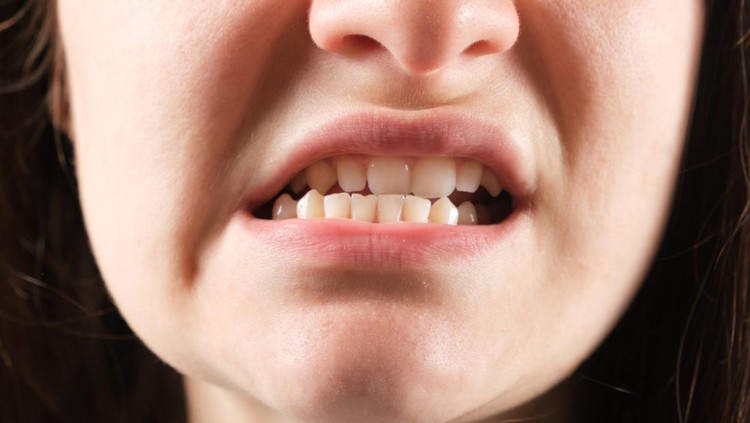 1395539303 Patient with dislocated jaw and malocclusion, temporomandibular joint dysfunction, close-up