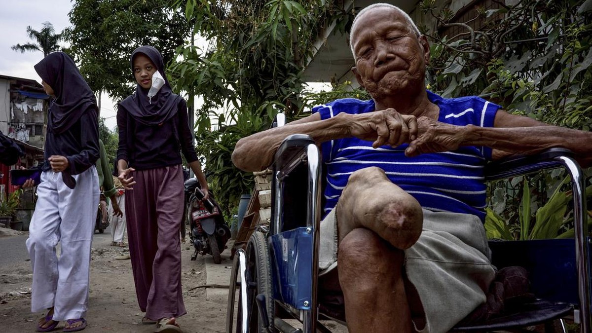 FOTO: Kaki dan Tangan Baru untuk Penyintas Kusta