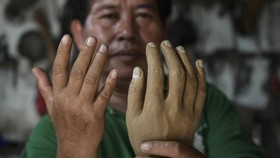 FOTO: Kaki dan Tangan Baru untuk Penyintas Kusta