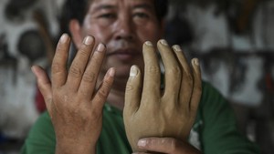 FOTO: Kaki dan Tangan Baru untuk Penyintas Kusta