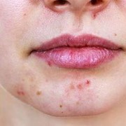 5 Penyebab Jerawat Tak Kunjung Sembuh dan Cara Mudah Mengatasinya