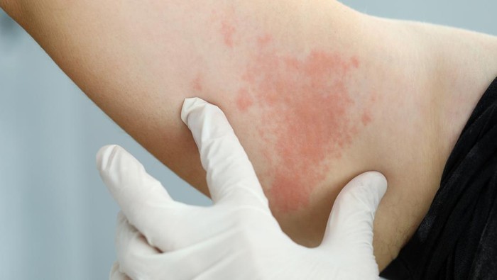 Focus on hand in glove of professional doctor looking at painful dermatological infection spreading throughout body of poor suffering patient. Professional dermatology clinic advertisement concept