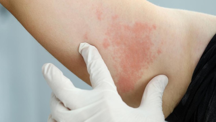 Focus on hand in glove of professional doctor looking at painful dermatological infection spreading throughout body of poor suffering patient. Professional dermatology clinic advertisement concept