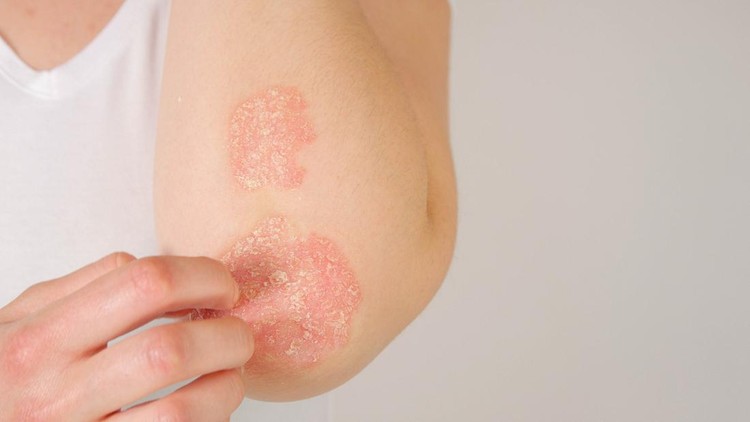 CLOSE UP: Unrecognizable young woman suffering from autoimmune incurable dermatological skin disease called psoriasis. Female gently scratching red, inflamed, scaly rash on elbows. Psoriatic arthritis
