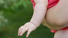 GEJALA KHAS CAMPAK PADA ANAK