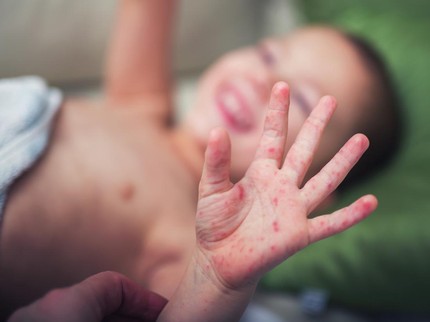 Mengenal Tampek pada Anak dan Bedanya dengan Campak, Penyebab Ruam hingga Gejalanya