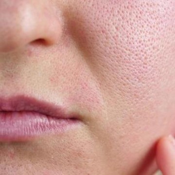 5 Rekomendasi Skincare untuk Mengecilkan Pori-Pori Wajah