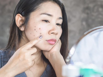 7 Cara Menghilangkan Bintik di Wajah Secara Alami dan Meratakan Warna Kulit